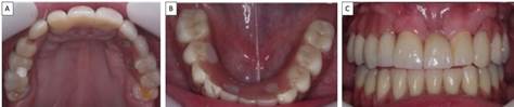 Final prosthetic rehabilitation: occlusal view of the maxilla and the mandible (A and B); frontal view of upper and lower prostheses (C).