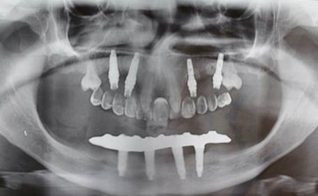 OPG after dental implant placements: four dental implants in the maxilla and four in the mandible, supporting fixed dental prostheses.