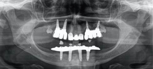 OPG after 10years of dental implant placements
