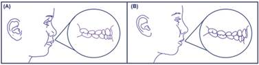 Esquema que representa los dos grupos de este estudio, con su correspondiente dentición. (A) Dentición temporal completa. (B) Dentición mixta primera fase.