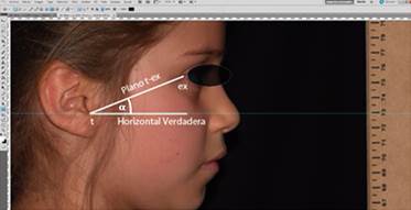 Trazado del plano t-ex, la horizontal verdadera y el ángulo formado entre ambos (α), mediante el programa Adobe Photoshop CS6®. Tanto la paciente como su tutor legal autorizaron la publicación de esta fotografía.