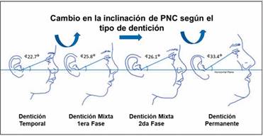 Esquema muestra el cambio de la inclinación de PNC a través de las distintas denticiones (esquema gentileza del Dr. Cristián Vergara Núñez).