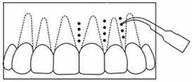 Piezopunctures around each tooth at the intervention side.