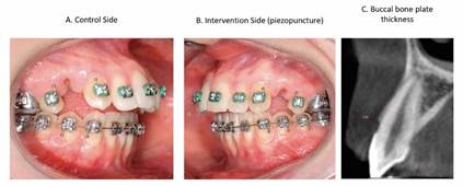 Baseline view of the control side (A), Intervention side - piezopuncture (B) and C) the buccal bone plate thickness.