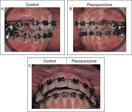 Intraoral view of the control side (A) the intervention side (B) and a front view (C), showing greater canine distalization with piezopuncture, after 15 days of orthodontics forces application.