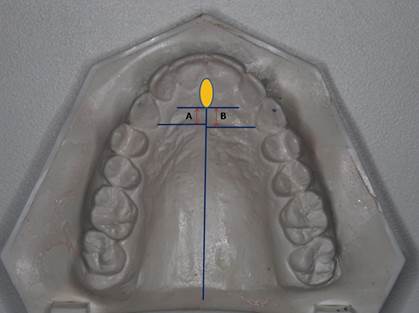 Progress in the movement of the teeth was evaluated by measuring the distance from the incisive papilla to a line drawn perpendicular to the middle raphe from the center of each canine cingulum. The initial distance of the right (A) and left (B) canine cingulum to the incisive papilla, was recorded as baseline.
