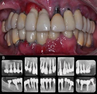 Situación clínica preoperatoria 1b Rx Seriada. Nótese pérdida ósea alrededor de numerosos implantes