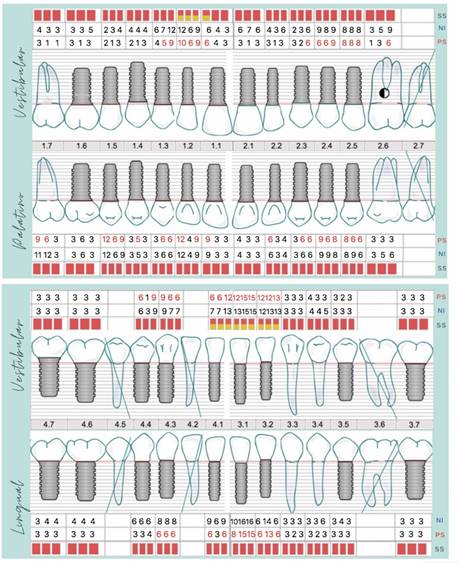 Periodontograma del Maxilar Superior y del Maxilar Inferior. No se incluye el implante en 3.8 debido a que el programa no incluye a 3ros molares.