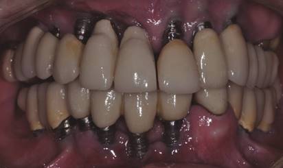 Re-evaluación 30 días posterior a la terapia no quirúrgica (T1).