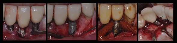 a. Abordaje Quirúrgico para la Explantación. b. Terapia resectiva. Eliminación del tejido de granulación. c. Implantoplastía y detoxificación de la superficie del implante frotando una gasa con yodopovidona. d. Terapia resectiva en zona palatina del maxilar superior.