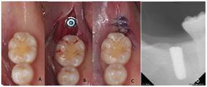 Colocación de implante dental. A) Fotografia inicial, B) Vista oclusal de la colocación del implante, C) Sutura del sitio quirúrgico, D) Radiografía periapical de la colocación del implante.