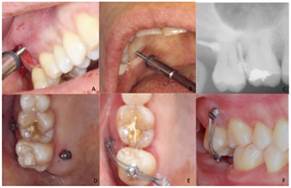 Colocación de microtornillos. A) Colocación de microtornillo en vestibular, B) Colocación en palatino, C) Vista radiográfica de la colocación, D) Vista clínica de los microtornillos, E) Vista oclusal de la colocación del botón oclusal, F) Vista vestibular del botón oclusal.