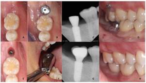 Rehabilitación del implante. A) Vista oclusal del sitio del implante a los 5 meses, B) Descubrimiento del implante y colocación del tornillo de cicatrización, C) Vista radiográfica del tornillo de cicatrización, D) Vista vestibular, E) Perfil de emergencia del sitio, F) G) y H) Reabilitación del implante dental
