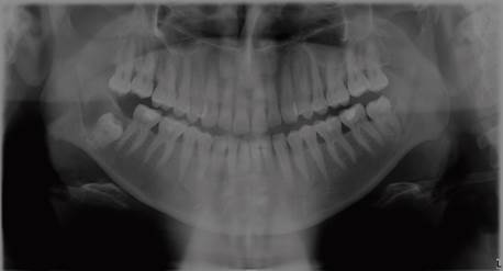 Radiografía panorámica cuando se pesquisa la lesión. Se observa extensa área radiolúcida, con márgenes netos, asociado a un tercer molar incluido.