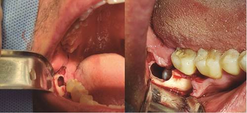(A) Colgajo triangular con osteotomía para lograr una apertura de la lesión quística. (B) Localización de la pieza 4.8.