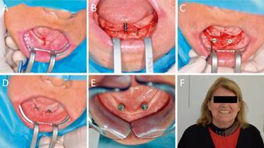 Sobredentadura mandibular implanto retenida en 2 implantes. A) situación inicial, detalle de la incisión. B) Instalación de implantes interforaminales. C) distancia ideal entre implantes interforaminales. D) posoperatorio inmediato E) posoperatorio 12 semanas. F) prótesis total mandibular implanto retenida instalada.