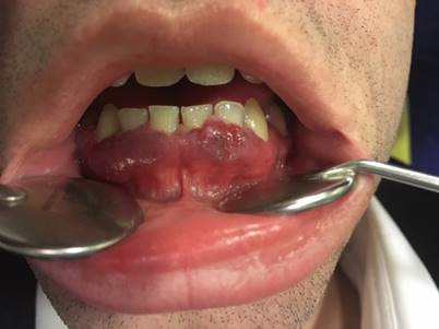 Manifestaciones clínicas: La fotografía clínica preoperatoria muestra un agrandamiento gingival asociado de color rojo violáceo y abundante sangrado a la exploración.