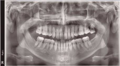 Radiografía panorámica: La radiografía panorámica no mostró un compromiso óseo de la lesión gingival.