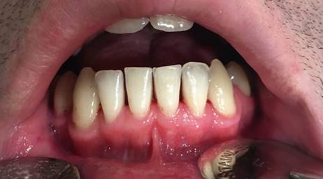Aspecto clínico luego del tratamiento: Fotografía clínica tomada 1 año luego de la resección quirúrgica muestra un tejido gingival sano, libre de inflamación.