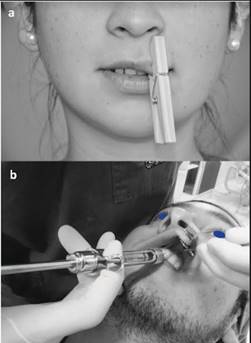 (a) type of wooden clothes peg used as an instrument for skin compression on the upper lip on the subject’s left side and (b) method of anesthetic injection. Note the separation of the lip with mirror observing the puncture point.