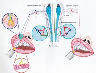 Pain gating in the trigeminal spinal nucleus based on that proposed by Melzack and Wall4 in the context of the trigeminal pain pathway. During needle punction and infiltration of local dental anesthesia administration, tissue damage causes release of inflammatory mediators that stimulate nociceptors that initiate the pain pathway. Our results suggest that stimulation of cutaneous mechanoreceptor such as placing a wooden clothes peg (green) prior to the anesthetic injection stimulate in large-diameter (non-nociceptive) myelinated (A-β) primary afferents (blue axon) ‘‘turned on’’ an inhibitory interneuron (black neuron), which in turn inhibited the trigeminal spinal projection neurons (green axon) that transmit the injury message to the brain.