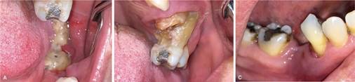 (A) Lesión exofítica ubicada en sextante 4. (B) Lesión exofítica en relación a diente 2.6. (C) Fístula oral en zona edéntula de diente 4.5.