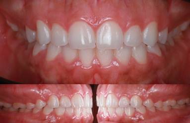 Initial photographs. (A) Frontal photograph. (B) Lateral photographs