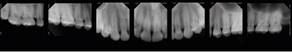 Periapical radiographs
