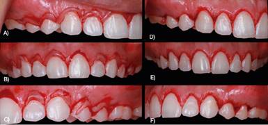 (A-C) Submarginal and intrasulcular incisions. (D-F) Internal bevel gingivectomy.