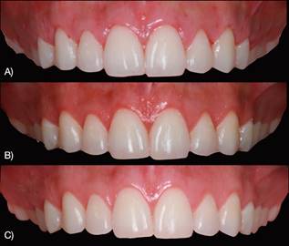 Post op after: (A) 7 days. (B) 1 month. (C) 6 months.