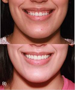 (A) Initial photograph. (B) One month after surgery.