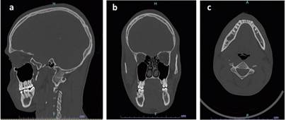 lesiones hipodensas aisladas una de la otra; TC cuerpo mandibular derecho (a) Corte Sagital, (b) Corte Coronal, (c) Corte Axial.