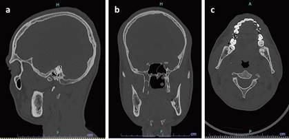 lesiones hipodensas aisladas una de la otra; TC rama mandibular derecha (a) Corte Sagital, (b) Corte Coronal, (c) Corte Axial.