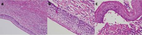 Estudio histopatolgico con tincin de hematoxilina y eosina arrojo muestra (a) magnificacin 10x; cavidad qustica recubierta por un epitelio plano pluriestratificado de 15-25 capas, acompaado de un infiltrado inflamatorio difuso del conectivo subyacente con disposicin en empalizada de su estrato basal, (b) magnificacin 40x; tendencia a disponerse en empalizada de su basal. Sin evidencia de estrato granuloso, (c) magnificacin 40x; desprendimiento del epitelio del conectivo de soporte, junto con reas de la superficie epitelial con patrn en chevron.