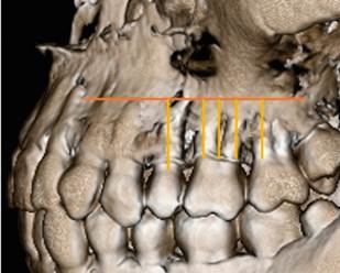 5 planos de referencia dentarios utilizados