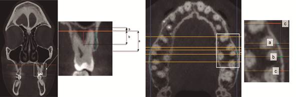 Plano cigomtico horizontal; (a) distancias cresta-plano cigomtico horizontal y (b) apical/furca -plano cigomtico horizontal.