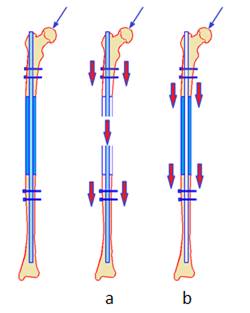 Vías en la distribución de cargas a
través del implante, a) pernos-clavo-pernos, b) espaciador, Laboratorio de
Biomecánica 2010.