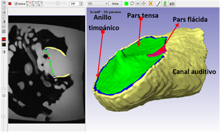 Ilustración del
canal auditivo, anillo timpánico y el tímpano (pars flácida y pars tensa).
