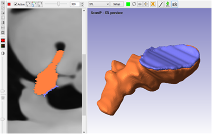 Construcción de la
junta incudomaleal en ScanIP.
