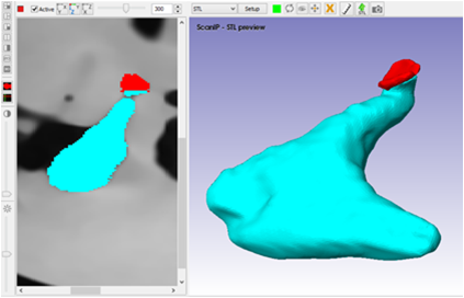  Construcción de la
junta incudoestapedal en el programa ScanIP.