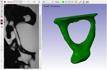 Construcción del
estribo en el programa ScanIP.