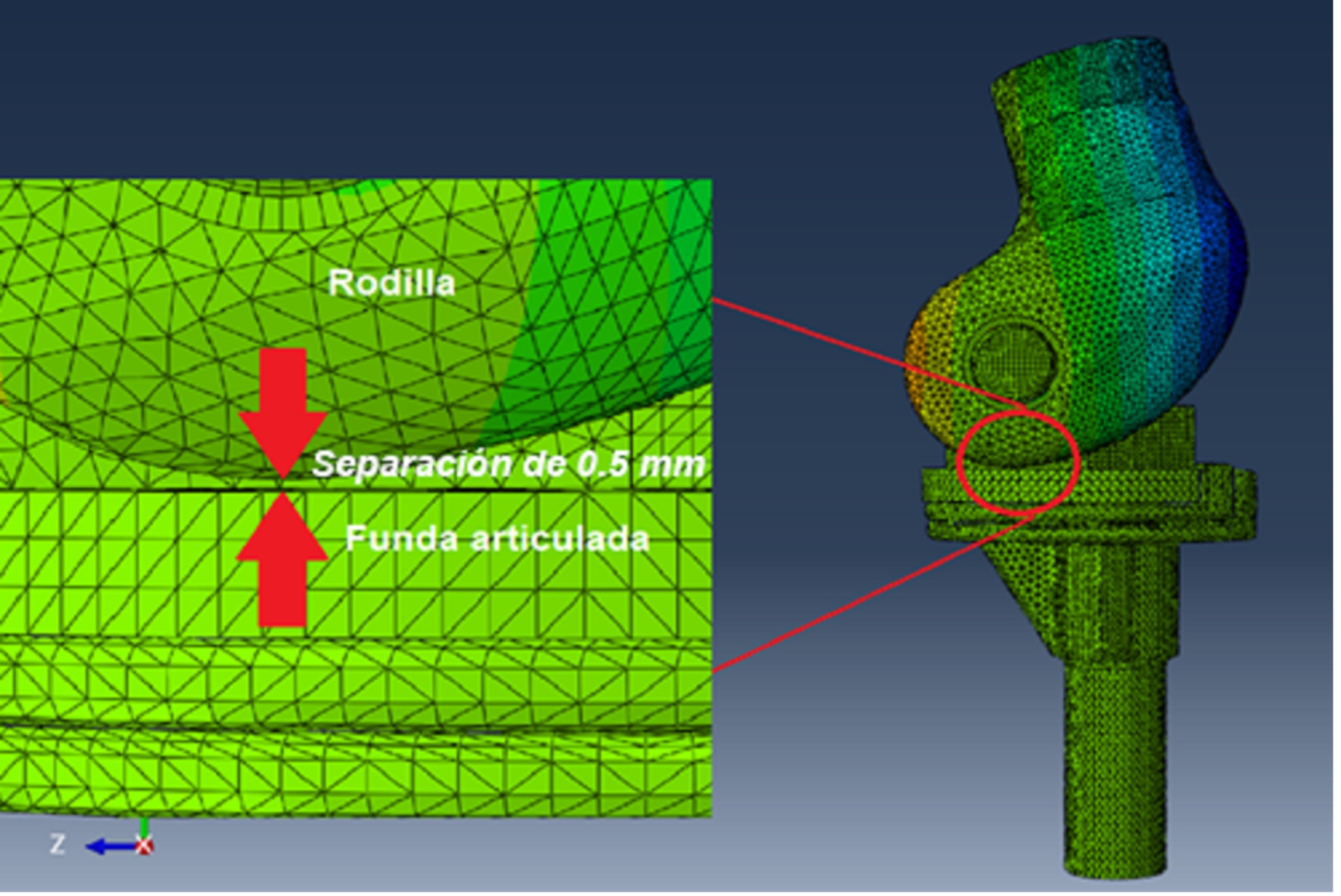 Separacin del componente femoral y funda articulada, ambos de aleacin de titanio (Ti-6Al-4V).
