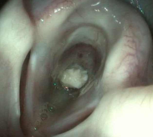 The appearance of the foreign body (an articular cartilage) in the respiratory tract of a Kangal dog during endoscopic examination.