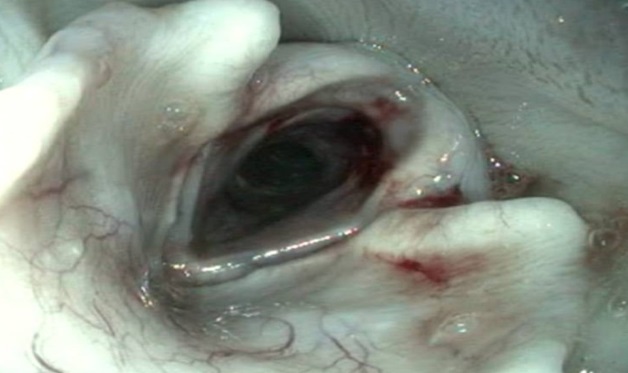 Endoscopic view of the respiratory tract after the foreign body was removed. Petechial hemorrhage foci are observed in the larynx cartilages.