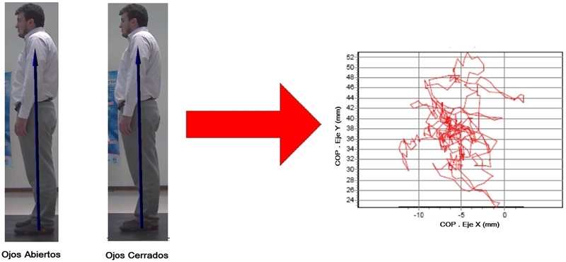 Esquema general de la prueba realizada siguiendo el test de Romberg. El vector sobre la imagen de la persona muestra la posici&oacute;n del centro de presi&oacute;n, cuyo desplazamiento sobre los ejes X y Y es presentado mediante un diagrama dispersi&oacute;n, tradicionalmente utilizado en los estudios cl&iacute;nicos de estabilometr&iacute;a.