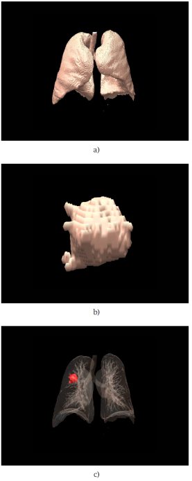 Reconstrucci&oacute;n tridimensional de las estructuras de inter&eacute;s, (a) Reconstrucci&oacute;n de los pulmones; (b) Reconstrucci&oacute;n en 3D del tumor pulmonar; (c) Reconstrucci&oacute;n de las estructuras de los pulmones y tumor en el mismo plano.