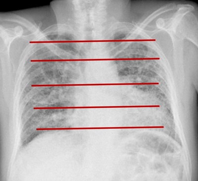 Ejemplo de ubicaci&oacute;n de 5 im&aacute;genes bidimensionales a diferentes alturas del pulm&oacute;n. Las im&aacute;genes seleccionadas est&aacute;n representadas por las l&iacute;neas rojas.