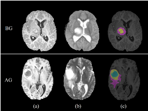 En la parte superior se muestra el caso de un paciente con un glioma de BG, mientras que en la parte inferior se muestra el caso para un paciente con glioma de AG. Se observan diferentes secuencias de RM as&iacute; como regiones de inter&eacute;s, de acuerdo a las columnas: (a) IRM T1c resalta las regiones activas y de necrosis, sobre todo en el caso de un glioma de AG; (b) IRM T2 resalta la regi&oacute;n del edema para ambos casos; y (c) muestra las segmentaciones de las distintas regiones de inter&eacute;s (edema en color morado, regi&oacute;n activa en color amarillo, regi&oacute;n de necrosis en color azul y la regi&oacute;n del tumor entero est&aacute; conformada por la regi&oacute;n activa y la regi&oacute;n de necrosis).