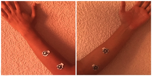 Colocaci&oacute;n bipolar de electrodos del m&uacute;sculo extensor (a) y m&uacute;sculo flexor (b).