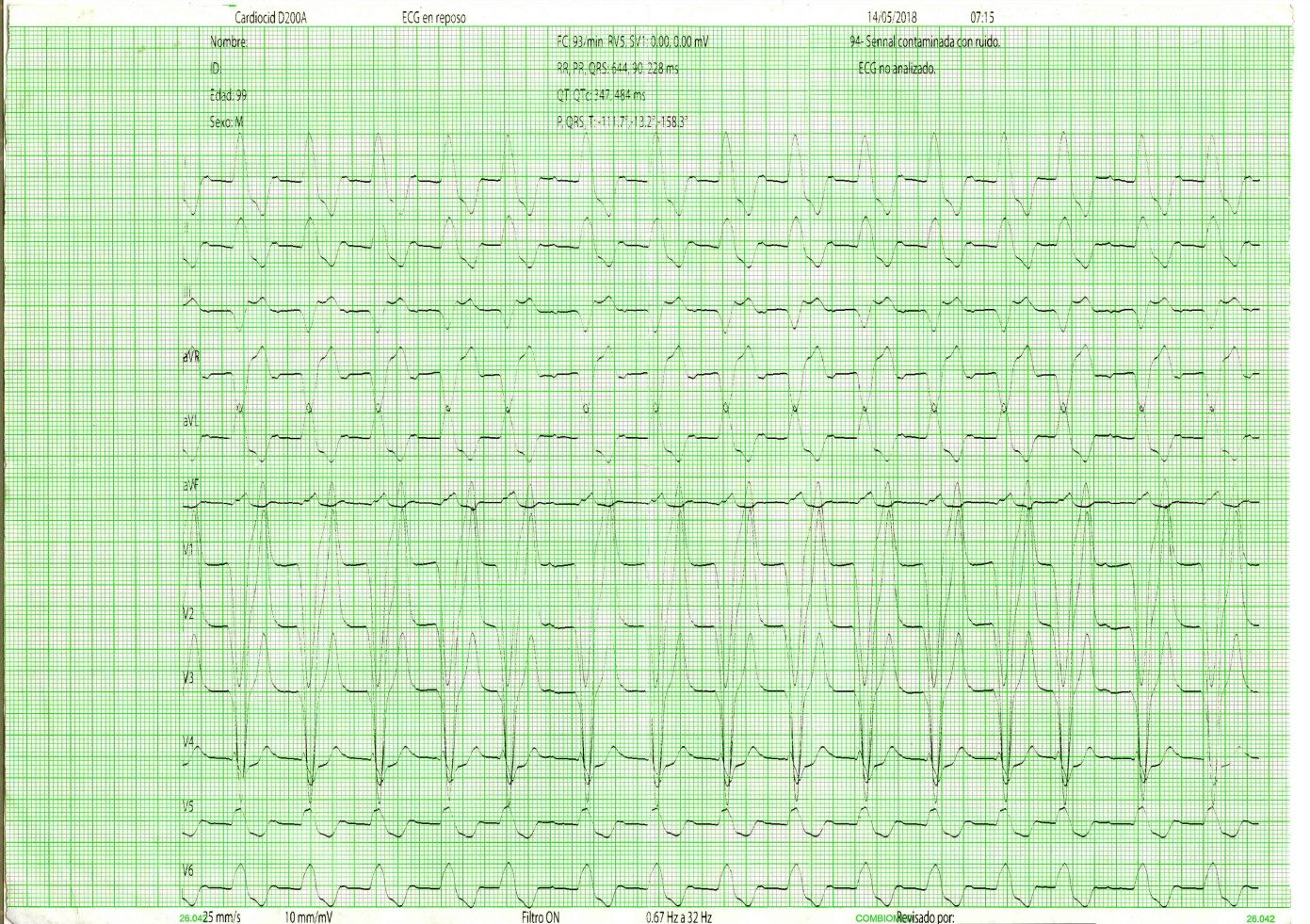 Picture 1. EKG with LBBB associated to Blockade AV of 1
              st degree
            